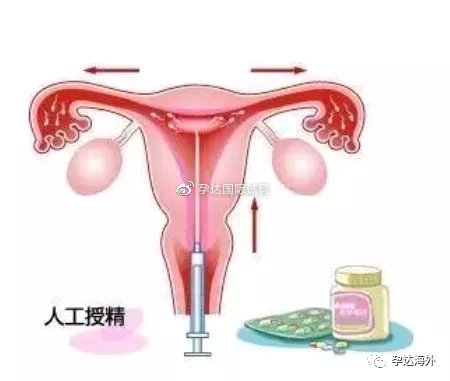 降低孕酮，取卵前的关键准备